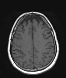File:Cerebellar metastasis (Radiopaedia 54578-60810 Axial T1 28).png