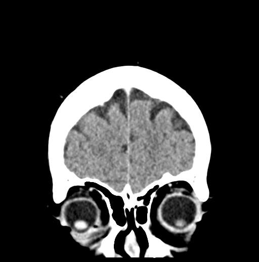 Cerebellar metastasis (Radiopaedia 54578-60812 Coronal C+ 8).png