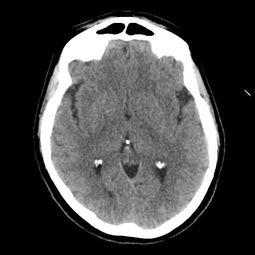 Cerebellar metastasis (cystic appearance) (Radiopaedia 41395-44258 Axial non-contrast 27).png