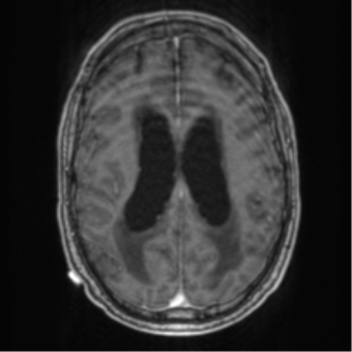 Cerebellar metastasis from lung adenocarcinoma (Radiopaedia 86690-102829 Axial T1 C+ 52).png