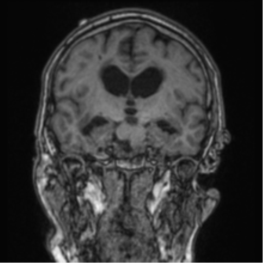 Cerebellar metastasis from lung adenocarcinoma (Radiopaedia 86690-102829 Coronal T1 55).png