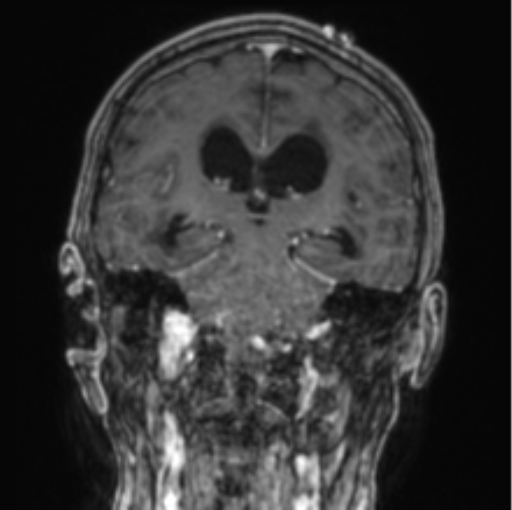 File:Cerebellar metastasis from lung adenocarcinoma (Radiopaedia 86690-102829 Coronal T1 C+ 46).png
