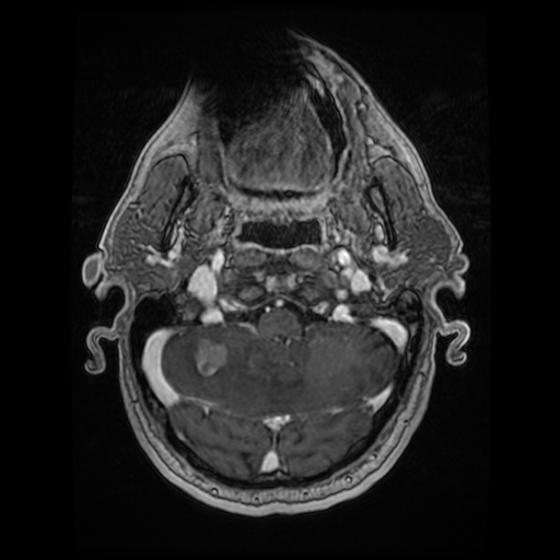 File:Cerebellar metastasis of pulmonary adenocarcinoma, cavernous venous malformation, and developmental venous anomaly (Radiopaedia 85827-101661 Axial T1 C+ 23).jpg
