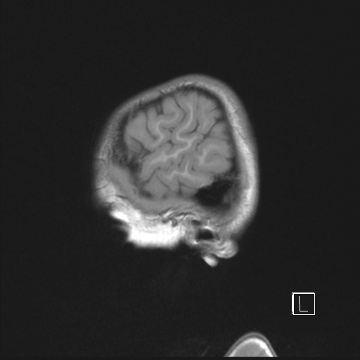 Cerebellar stroke (Radiopaedia 32202-33150 Sagittal T1 C+ 3).png