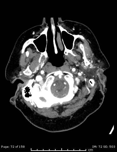 File:Cerebellar strokes due to intracranial giant cell arteritis (Radiopaedia 68799-78510 CT angiogram 72).jpg