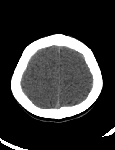 File:Cerebellitis (Radiopaedia 63148-71665 Axial non-contrast 8).jpg