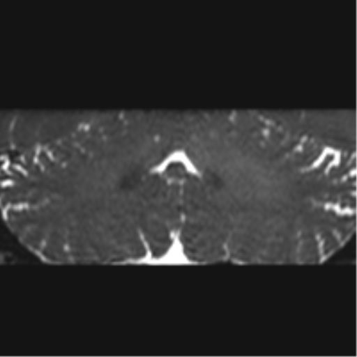 Cerebellopontine angle meningioma (Radiopaedia 48434-53348 Coronal T2 23).png