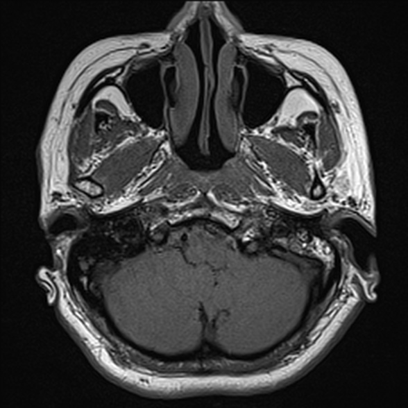 File:Cerebellopontine angle meningioma (Radiopaedia 53561-59591 Axial T1 4).jpg