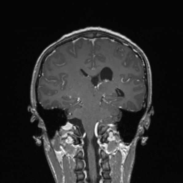 File:Cerebral abscess (Radiopaedia 24212-24478 Coronal T1 C+ 129).jpg