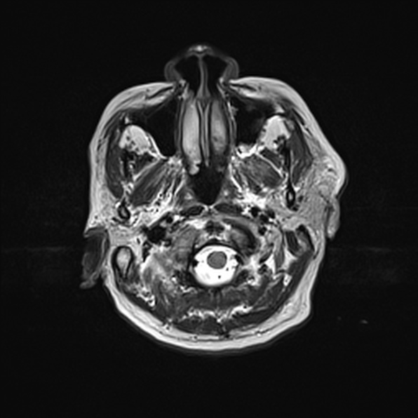 Cerebral abscess (Radiopaedia 26111-26247 Axial T2 9).jpg