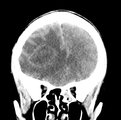 Cerebral abscess (Radiopaedia 60342-68008 Coronal non-contrast 19).png