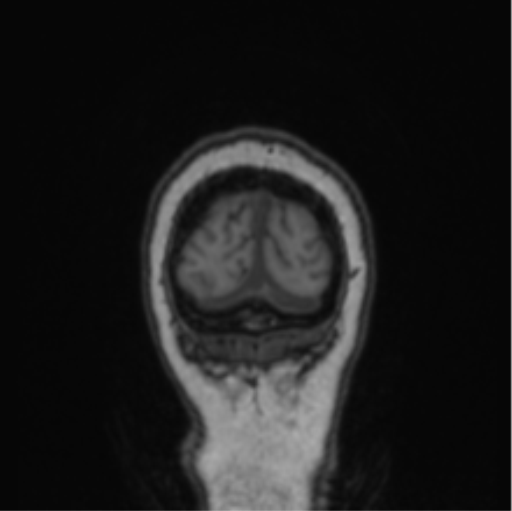 File:Cerebral abscess from pulmonary arteriovenous malformation (Radiopaedia 86275-102291 Coronal T1 10).png