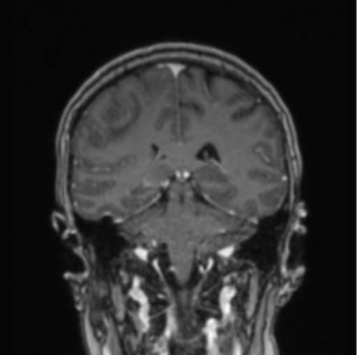 Cerebral abscess from pulmonary arteriovenous malformation (Radiopaedia 86275-102291 L 37).png