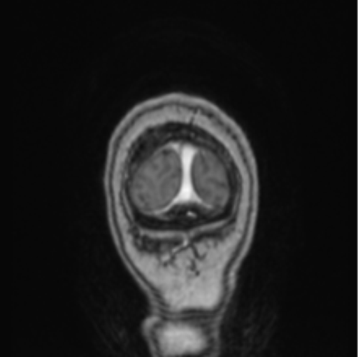 Cerebral abscess from pulmonary arteriovenous malformation (Radiopaedia 86275-102291 L 8).png