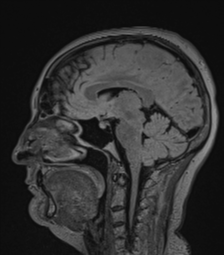 Cerebral abscess from pulmonary arteriovenous malformation (Radiopaedia 86275-102291 Sagittal FLAIR 39).png