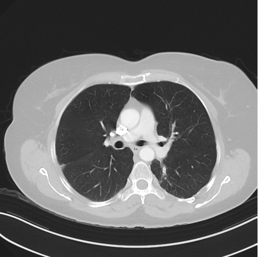 Cerebral abscess from pulmonary arteriovenous malformation (Radiopaedia 86275-102292 Axial lung window 26).png