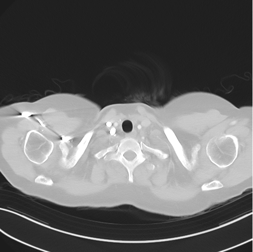 Cerebral abscess from pulmonary arteriovenous malformation (Radiopaedia 86275-102292 Axial lung window 6).png