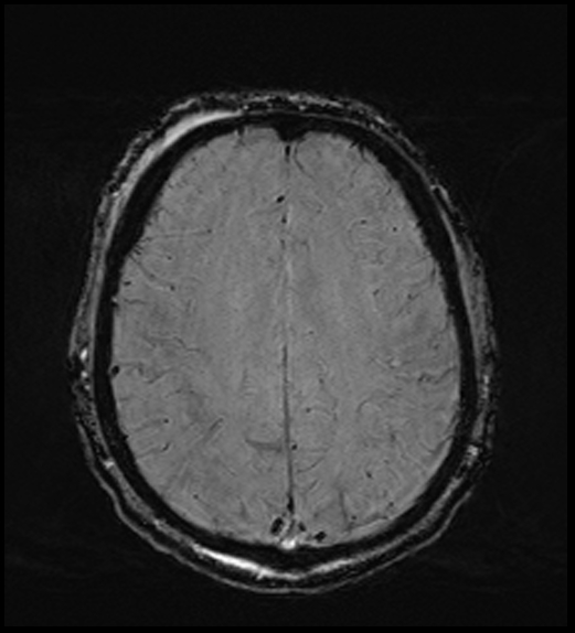Cerebral abscess with ventriculitis (Radiopaedia 78965-91878 Axial SWI 38).jpg