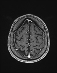 Cerebral amyloid angiopathy-related inflammation (Radiopaedia 58270-65377 Axial T1 C+ fat sat 124).jpg