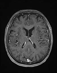Cerebral amyloid angiopathy-related inflammation (Radiopaedia 58270-65377 Axial T1 C+ fat sat 86).jpg