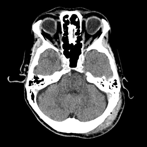 Cerebral amyloid angiopathy-related inflammation (Radiopaedia 74836-85848 Axial non-contrast 19).jpg