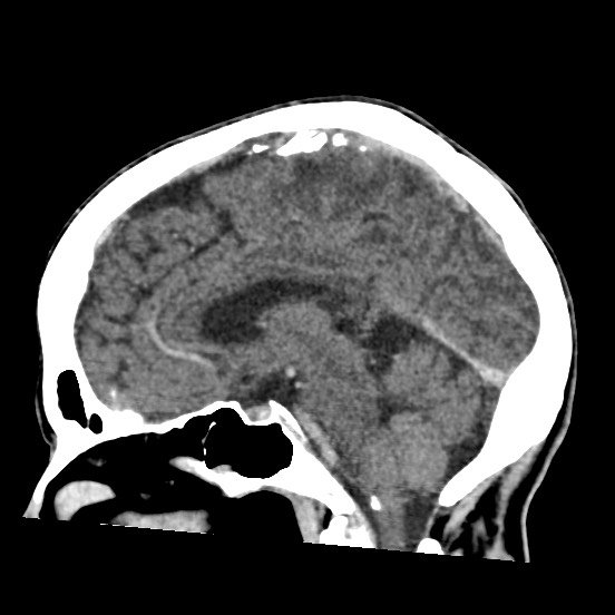 Cerebral amyloid angiopathy-related inflammation (Radiopaedia 74836-85848 C 29).jpg