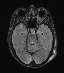File:Cerebral amyloid angiopathy-related inflammation (Radiopaedia 74836-85849 Axial FLAIR 11).jpg