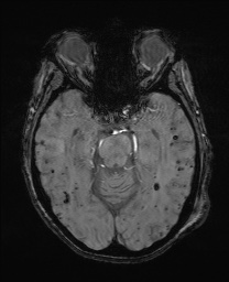 File:Cerebral amyloid angiopathy-related inflammation (Radiopaedia 74836-85849 Axial SWI 27).jpg