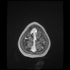 Cerebral and spinal tuberculosis (Radiopaedia 90489-107837 Axial T1 C+ 177).jpg