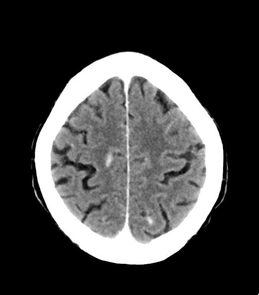 File:Cerebral aneurysm with rupture (Radiopaedia 29933-30460 Axial non-contrast 22).jpg