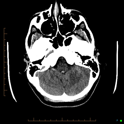 File:Cerebral arteriovenous malformation (AVM) (Radiopaedia 78162-90706 Axial non-contrast 15).jpg