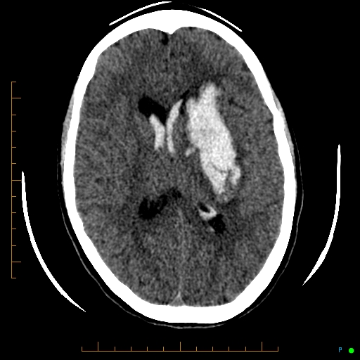 Cerebral arteriovenous malformation (AVM) (Radiopaedia 78162-90706 Axial non-contrast 37).jpg