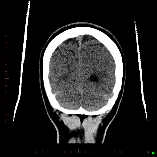 Cerebral arteriovenous malformation (AVM) (Radiopaedia 78162-90706 Coronal non-contrast 84).jpg