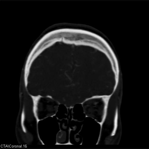 File:Cerebral arteriovenous malformation (Radiopaedia 28518-28759 C 16).jpg