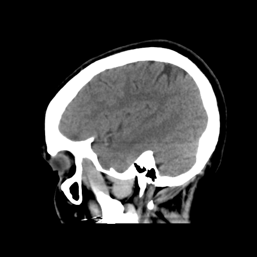 File:Cerebral arteriovenous malformation (Radiopaedia 39259-41505 B 11).png