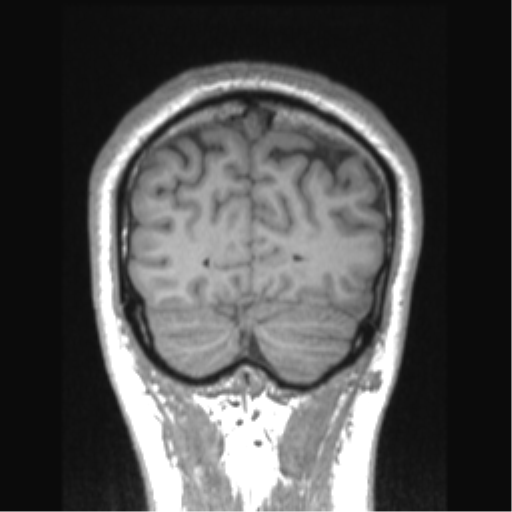 File:Cerebral arteriovenous malformation (Radiopaedia 39259-41506 Coronal T1 18).png