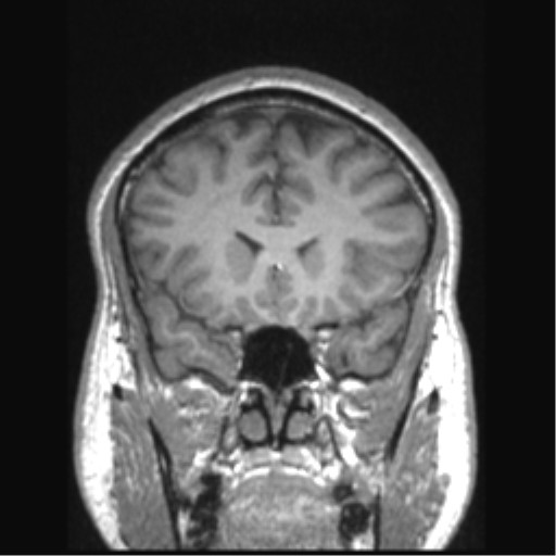 Cerebral arteriovenous malformation (Radiopaedia 39259-41506 Coronal T1 64).png