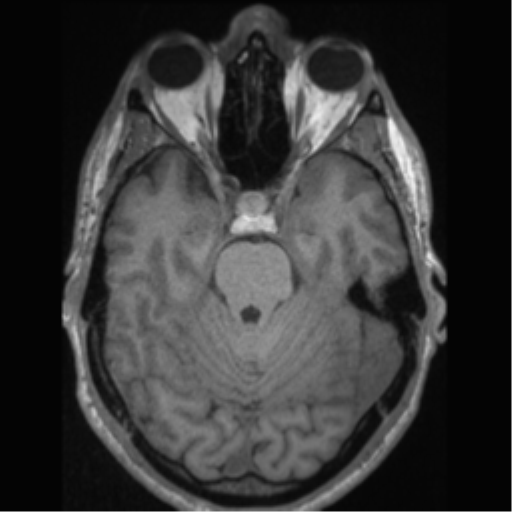 Cerebral arteriovenous malformation (Radiopaedia 55798-62372 Axial T1 20).png