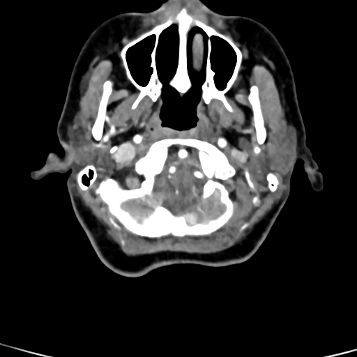 File:Cerebral arteriovenous malformation (Radiopaedia 73830-84645 B 92).jpg