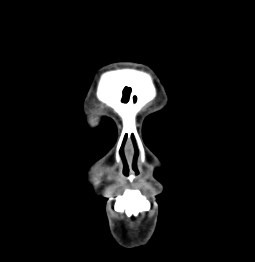 Cerebral arteriovenous malformation (Radiopaedia 73830-84645 C 5).jpg