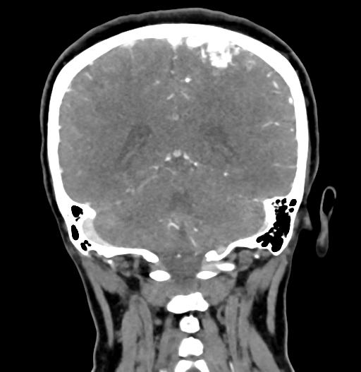 Cerebral arteriovenous malformation (Radiopaedia 73830-84645 C 68).jpg