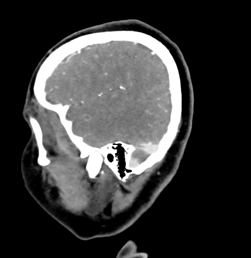 Cerebral arteriovenous malformation (Radiopaedia 73830-84645 D 17).jpg