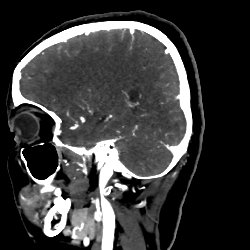 Cerebral arteriovenous malformation (Radiopaedia 73830-84645 Sagittal C+ delayed 29).jpg