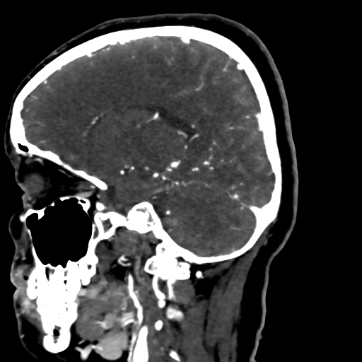 File:Cerebral arteriovenous malformation (Radiopaedia 73830-84645 Sagittal C+ delayed 35).jpg