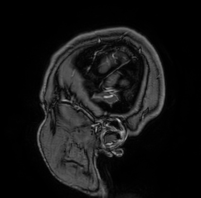 Cerebral arteriovenous malformation (Radiopaedia 74411-85654 Sagittal T1 C+ 4).jpg