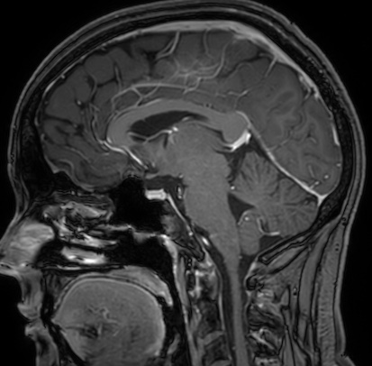 Cerebral arteriovenous malformation (Radiopaedia 74411-85654 Sagittal T1 C+ 64).jpg