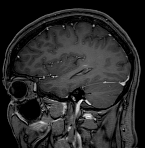 Cerebral arteriovenous malformation (Radiopaedia 74411-85746 Sagittal T1 C+ 31).jpg