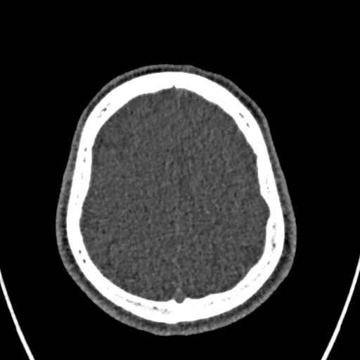 Cerebral arteriovenous malformation (Radiopaedia 78188-90746 Axial non-contrast 146).jpg
