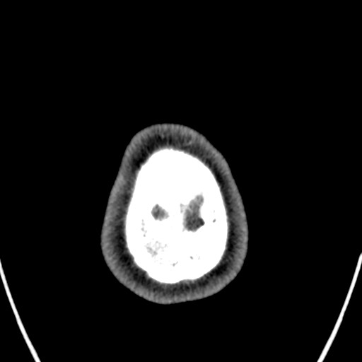 Cerebral arteriovenous malformation (Radiopaedia 78188-90746 Axial non-contrast 177).jpg