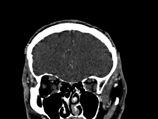 Cerebral arteriovenous malformation (Radiopaedia 78188-90746 Coronal C+ delayed 22).jpg